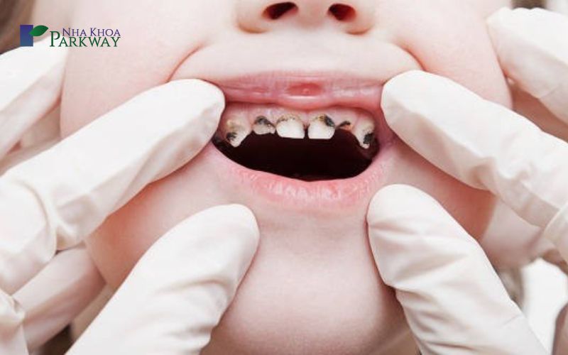 Nguyên nhân đau răng cửa hàm trên, hàm dưới