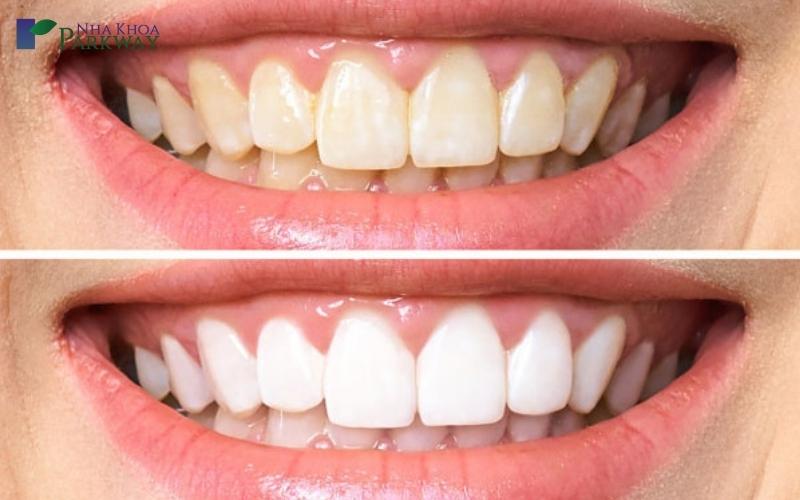 Tình trạng người bị ê buốt răng sau khi tẩy trắng răng