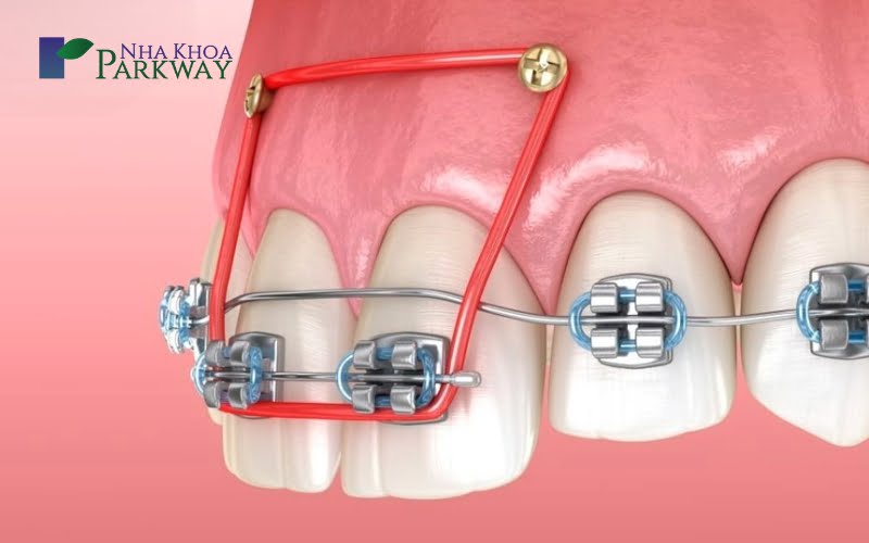 Các phương pháp ứng dụng trong đóng khoảng sau nhổ răng 