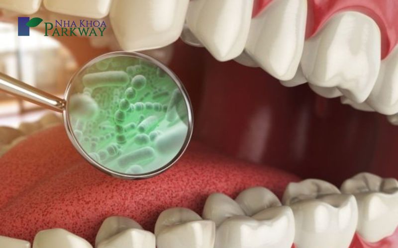 Vì sao bị lợi trùm răng cửa dễ dẫn đến viêm lợi trùm răng cửa?