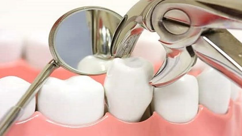 Nhổ răng cửa có đau không?