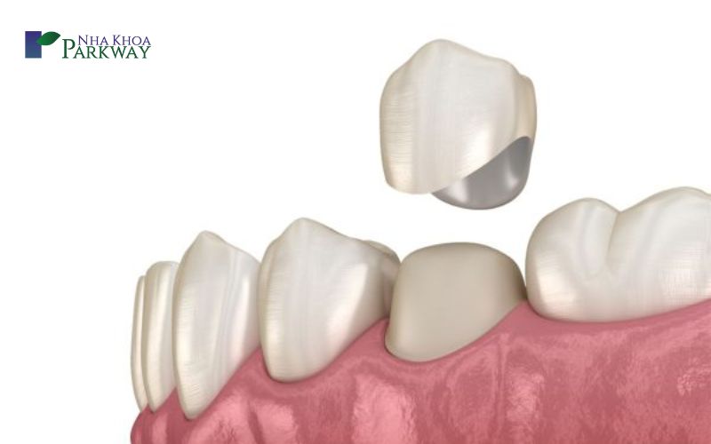 Cách điều trị tình trạng nứt răng cửa
