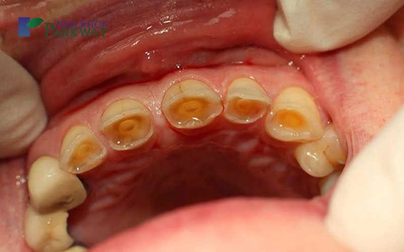 Ngà răng có vai trò cực kỳ quan trọng trong việc đảm bảo sức khỏe của răng
