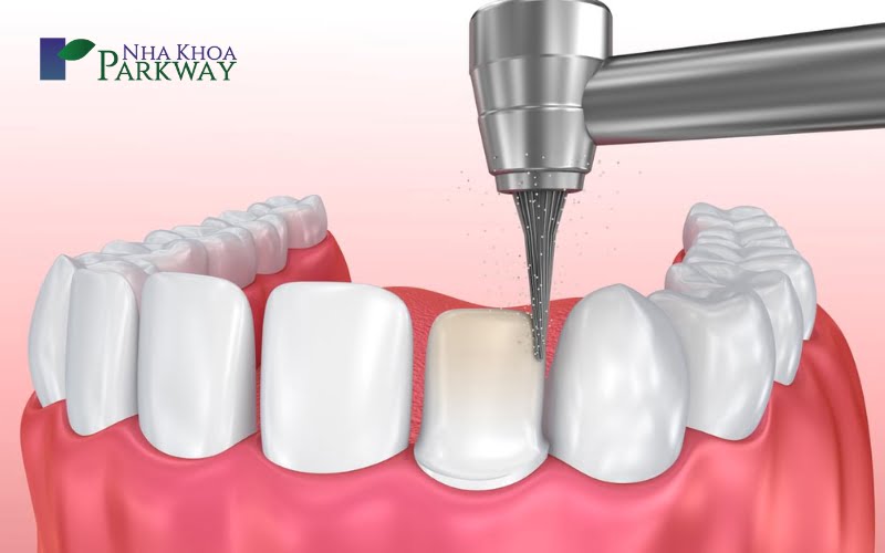 Cách điều trị răng cửa hô không cần phải nhổ bỏ răng