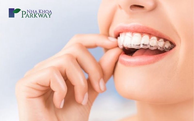 Cách điều trị răng cửa hô không cần phải nhổ bỏ răng