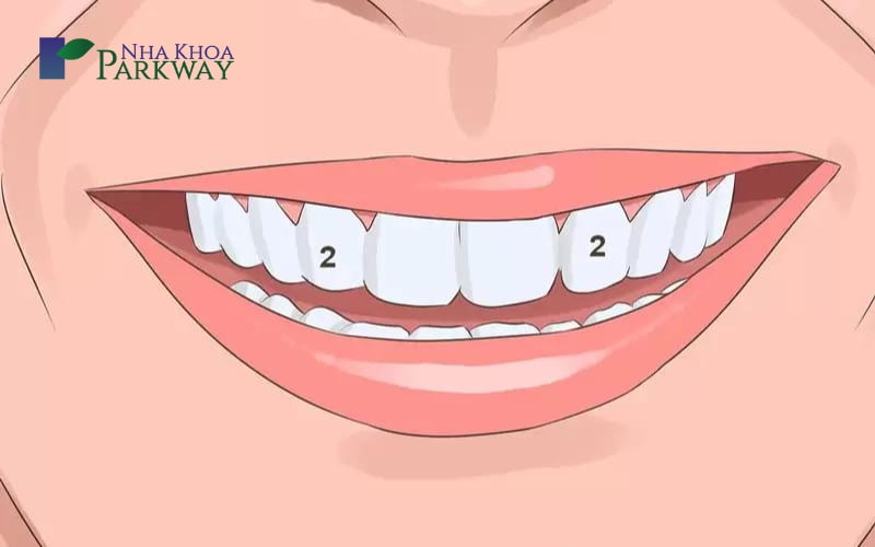 Nguyên nhân của tình trạng răng cửa mọc lệch hình chữ V
