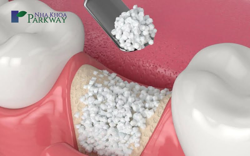 Cách điều trị răng cửa lung lay theo từng trường hợp