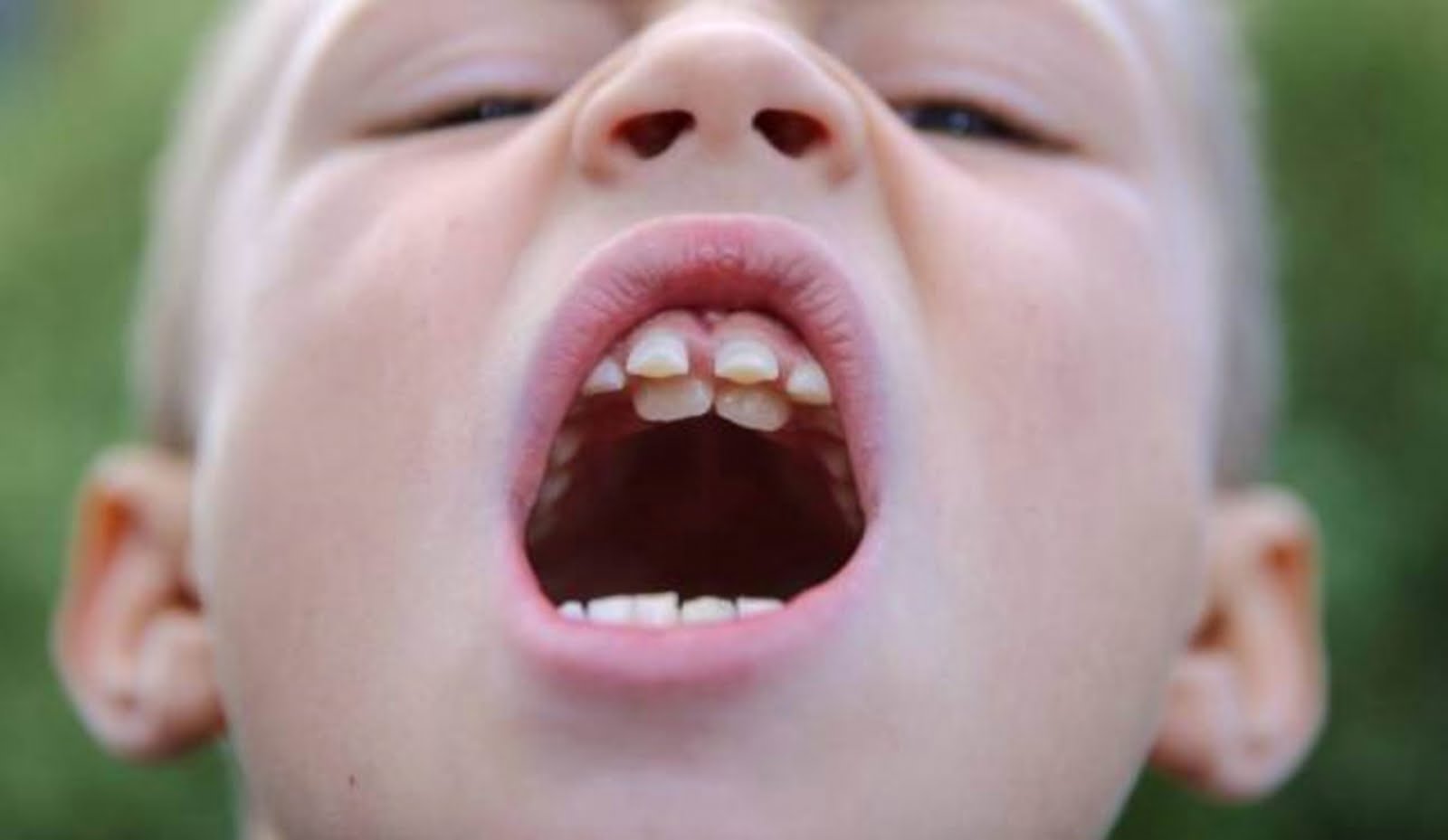Răng cửa mọc lệch ở trẻ em khắc phục như thế nào?