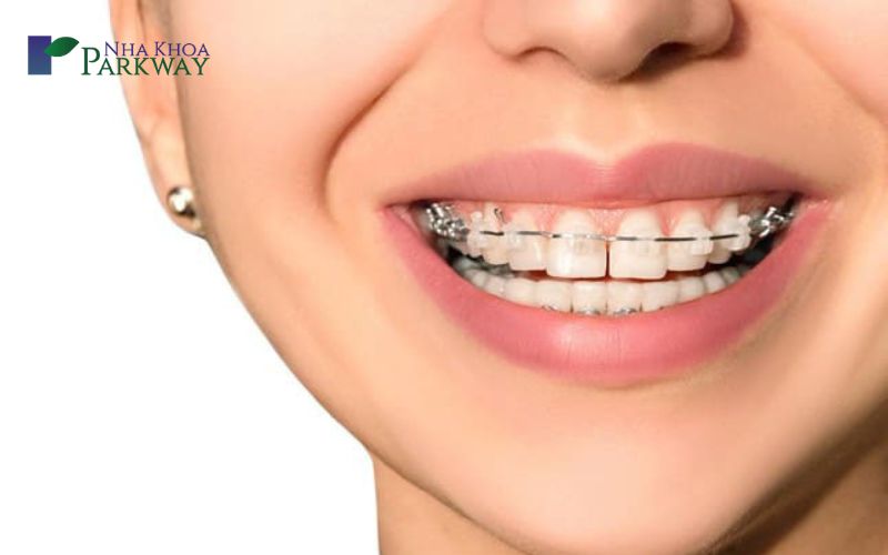 Răng thừa mọc giữa 2 răng cửa điều trị như thế nào?