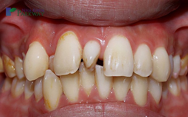 Nguyên nhân răng thưa mọc giữa 2 răng cửa là gì?