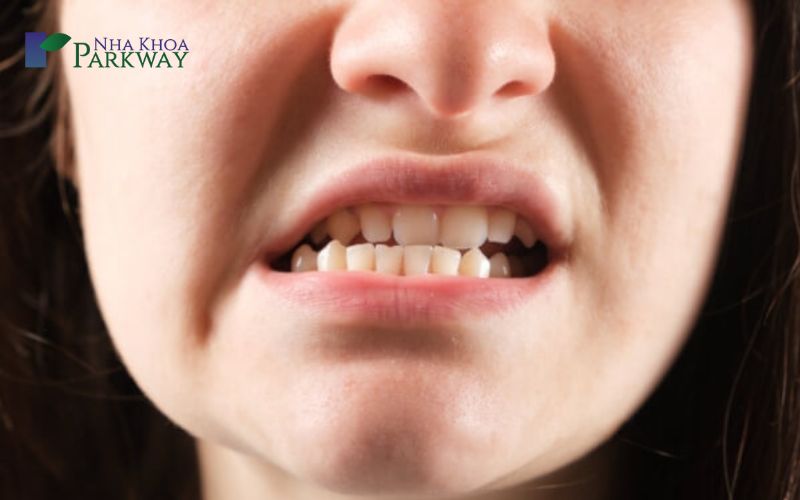 Hậu quả răng kẹt giữa 2 răng cửa
