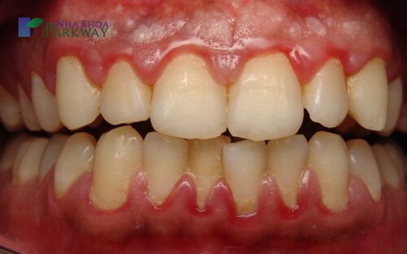 Nguyên nhân sưng nướu răng cửa hàm trên, hàm dưới là gì?