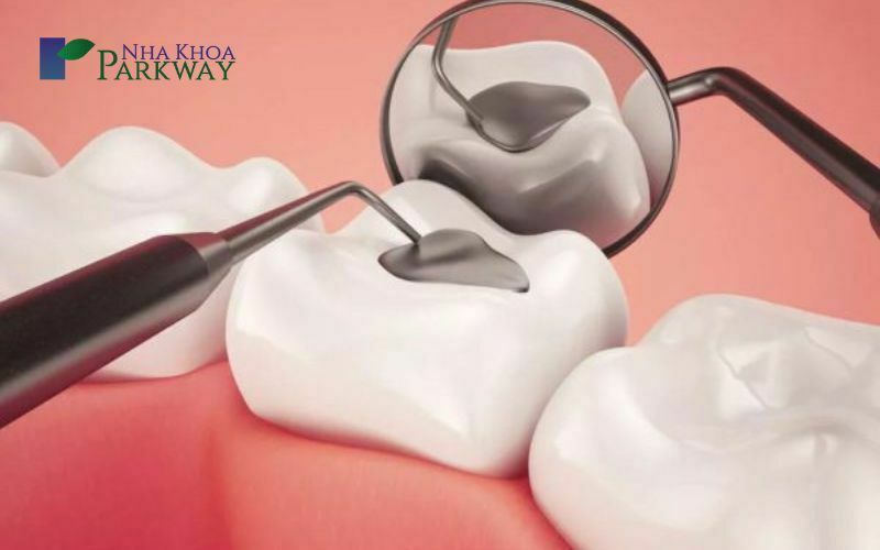 Trám răng à kỹ thuật nha khoa giúp phục hồi chức năng của răng bị hư hỏng