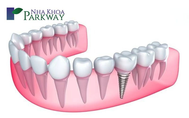 Đối tượng phù hợp với trồng răng hàm bằng cầu răng hay cấy ghép Implant