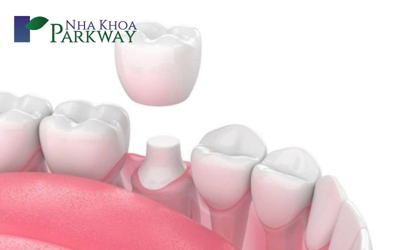 Đối tượng phù hợp với trồng răng hàm bằng cầu răng hay cấy ghép Implant