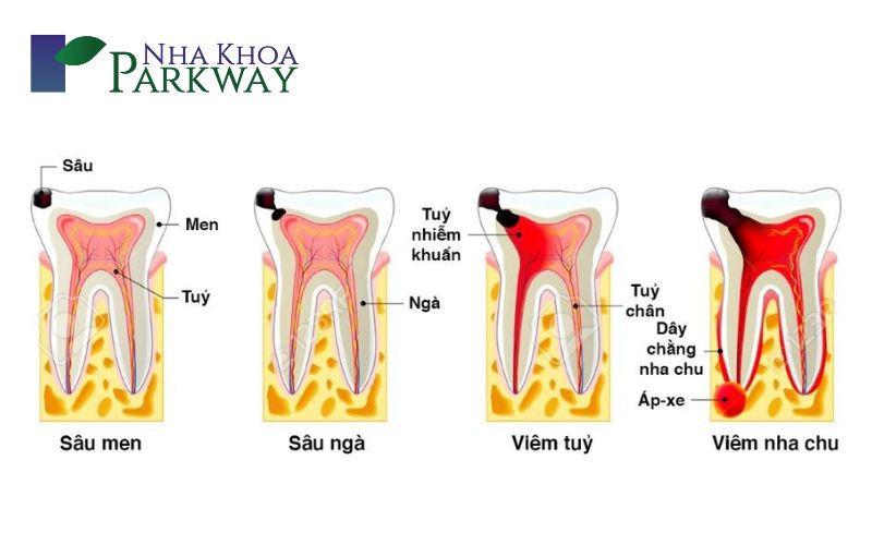 Các giai đoạn khi răng hàm bị sâu