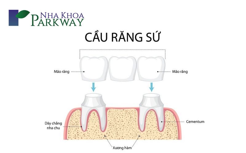 Các phương pháp trồng răng hàm bị sâu