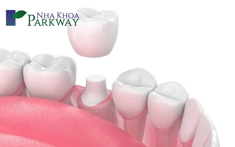 Vài phương pháp nha khoa để điều trị dứt điểm vết đen trên răng hàm 