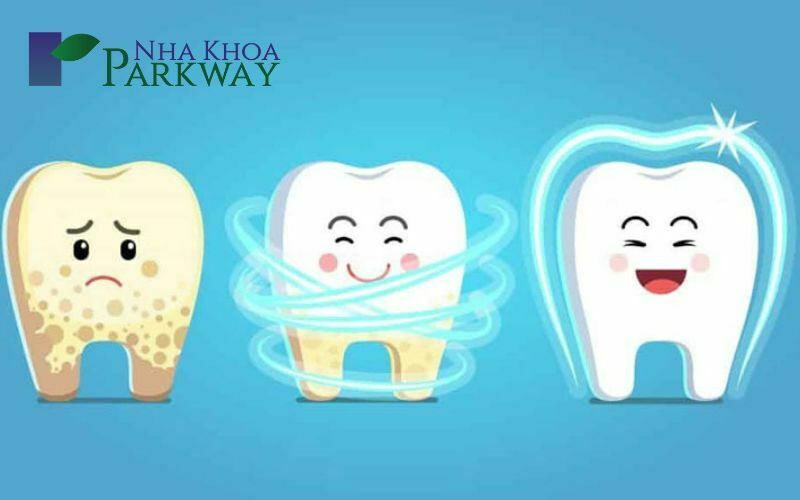 Cách điều trị dứt điểm viêm lợi răng hàm tại nha khoa