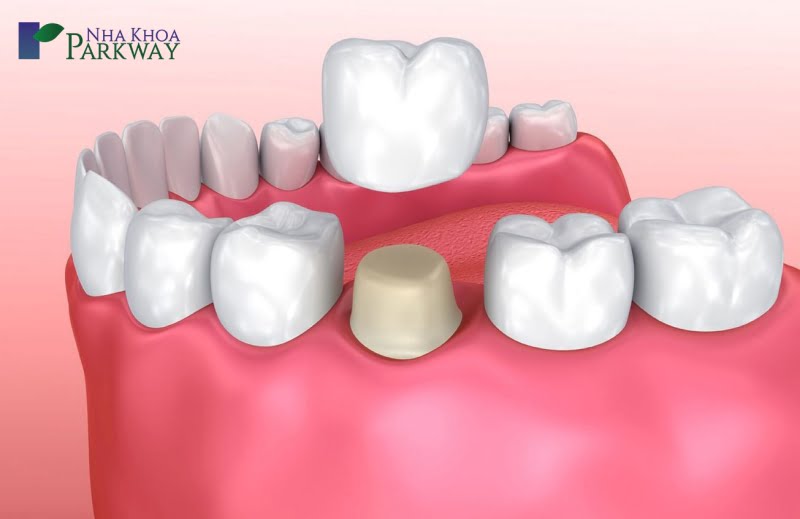 Cách chữa đau răng hàm tùy theo từng nguyên nhân