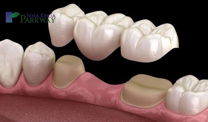 Trồng răng nanh bằng phương pháp Implant