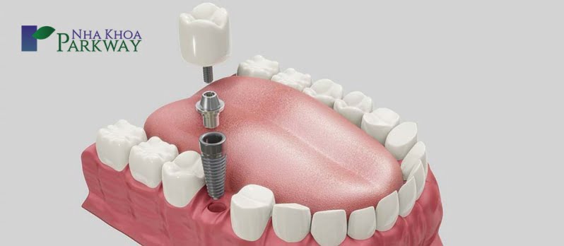 Trồng răng nanh bằng phương pháp Implant