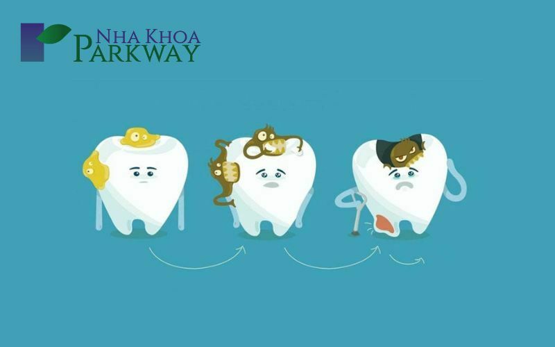 Những giai đoạn sâu răng hàm bị sâu phát triển