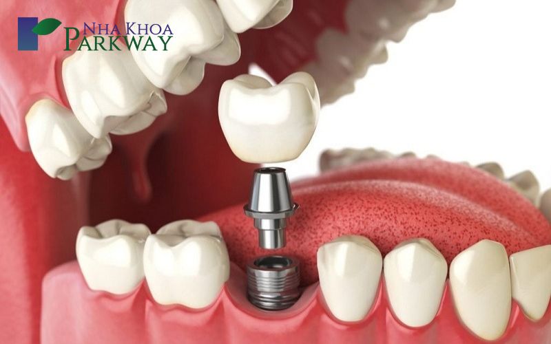 Làm răng nhân tạo bằng phương pháp cấy ghép implant