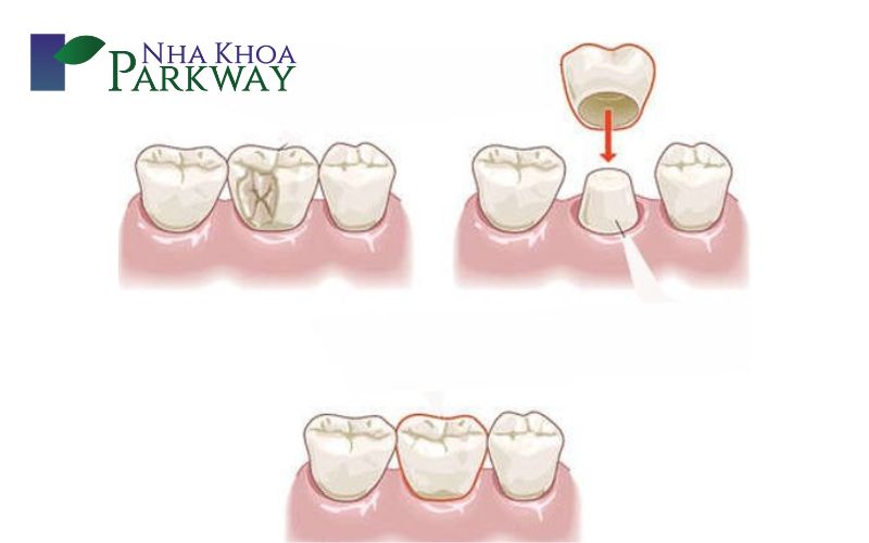 Cách xử lý răng hàm bị sâu chỉ còn chân răng