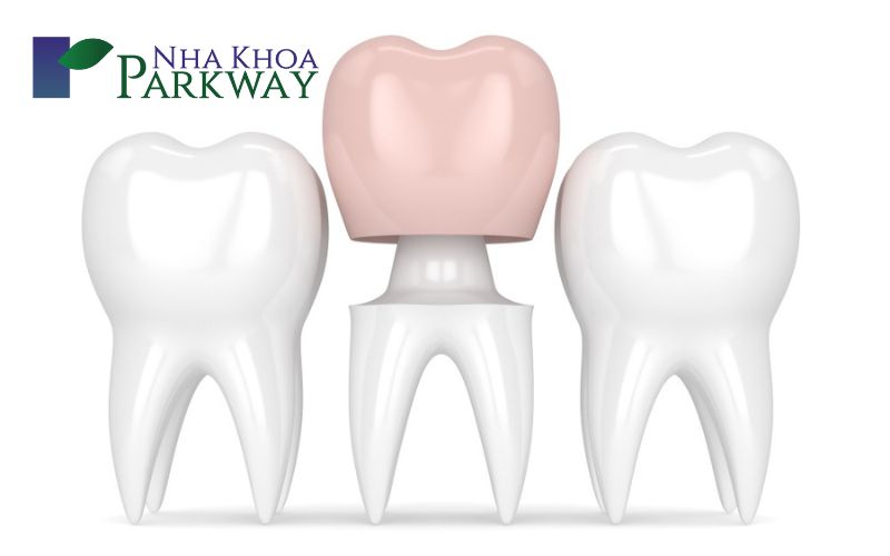 Các giải pháp phục hình răng hàm bị vỡ