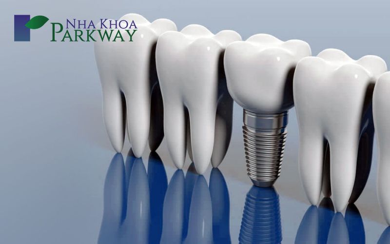 Phương pháp trồng răng bằng cấy ghép implant. 