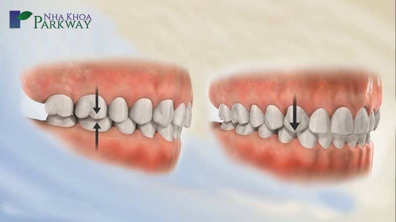 Ảnh hưởng của răng khểnh lên sức khỏe răng miệng