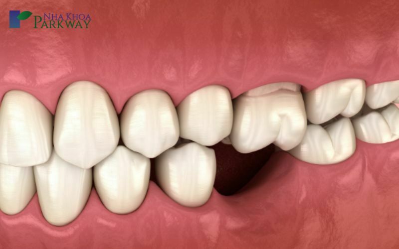 Mất răng gây răng những hậu quả không lường như nào?