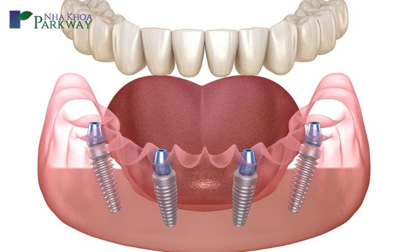 Gắn răng giả tạm thời trên Implant
