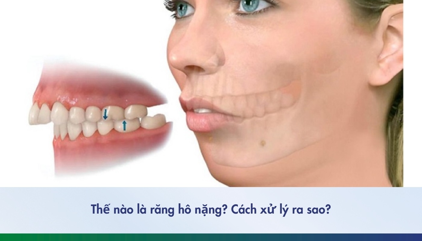 Thế nào là răng hô nặng