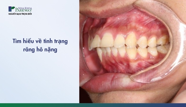 Tìm hiểu về tình trạng răng hô nặng