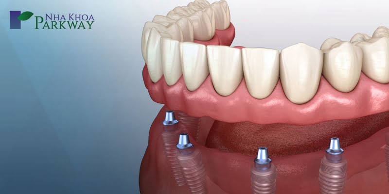 Những kỹ thuật làm răng nanh giả phổ biến và hiệu quả nhất