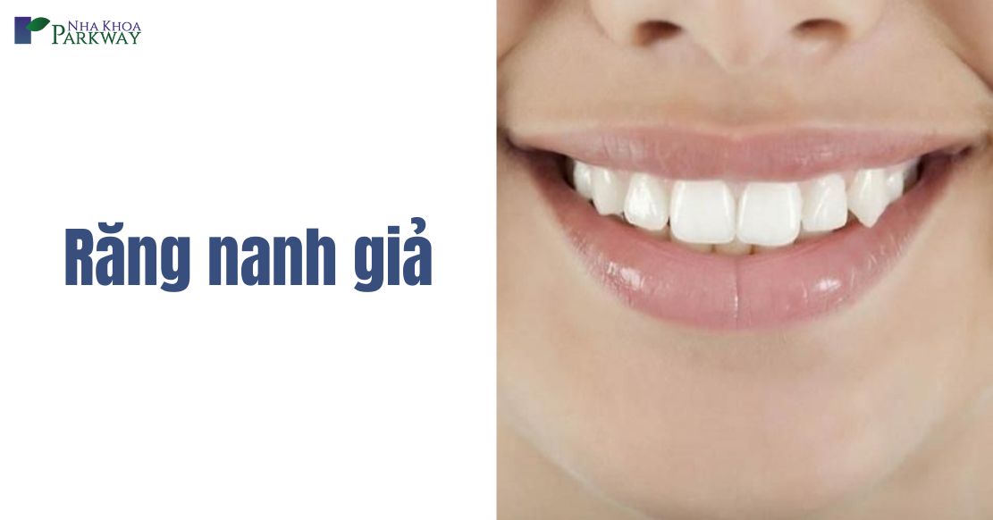 Có nên làm răng nanh giả hay không? Chi phí như thế nào?