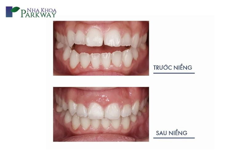 Hình ảnh trước và sau khi niềng răng hô hàm trên