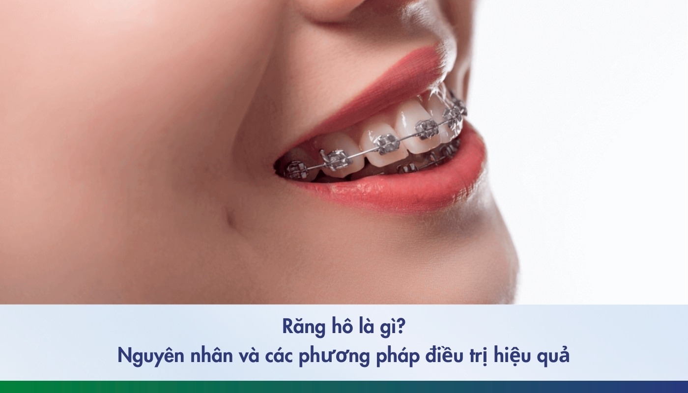 Các phương pháp điều trị răng hô
