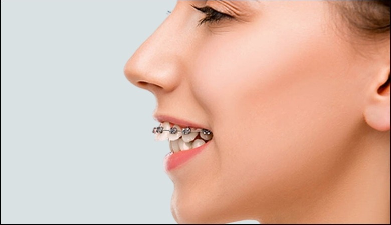 Chỉnh nha điều trị răng hô