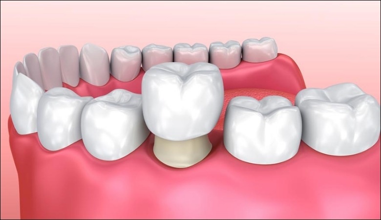Bọc răng sứ khắc phục răng hô