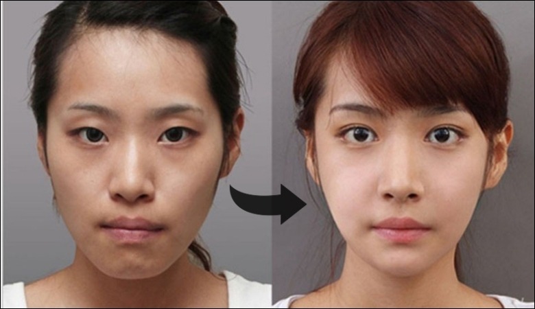 Phẫu thuật chỉnh hàm khắc phục răng hô nặng