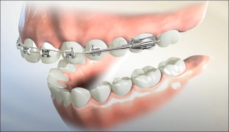 Kết hợp phẫu thuật hàm và niềng răng để điều trị hô