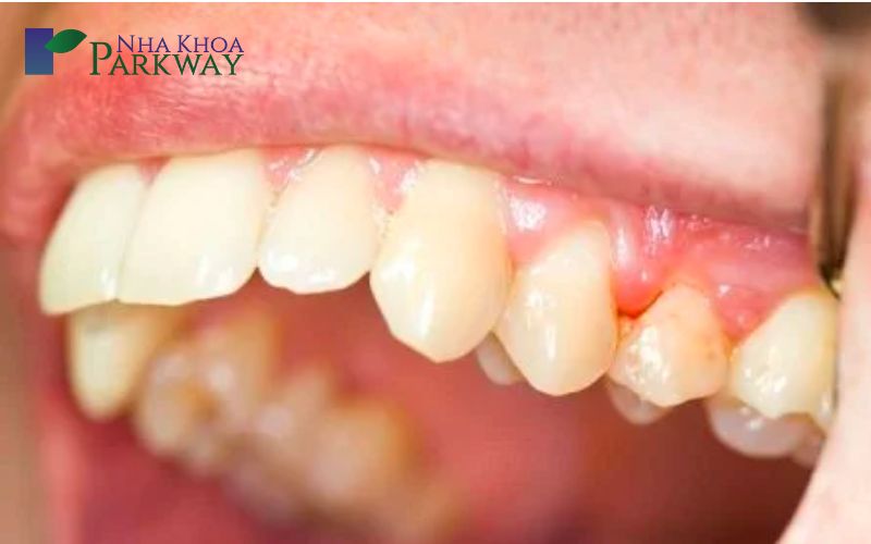 Viêm nướu răng cũng có thể dẫn đến tình trạng bị chảy máu chân răng khi ngủ 