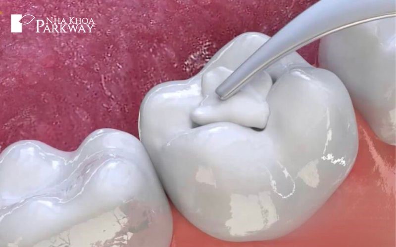 Điều trị tình trạng sâu răng để khắc phục tình trạng chân răng nổi cục trắng