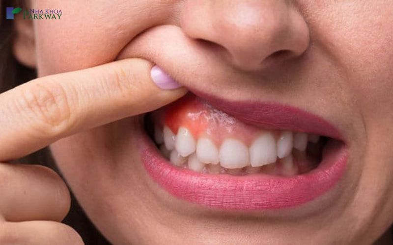 Bị các bệnh về răng làm thường xuyên bị chảy máu chân răng khi đánh răng