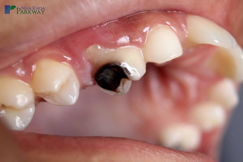 Bị sâu răng là một trong những nguyên nhân gây đau răng
