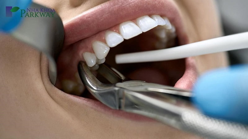 Lời giải đáp đang đau răng có nhổ được không chính là CÓ trong những trường hợp đau răng nhẹ 
