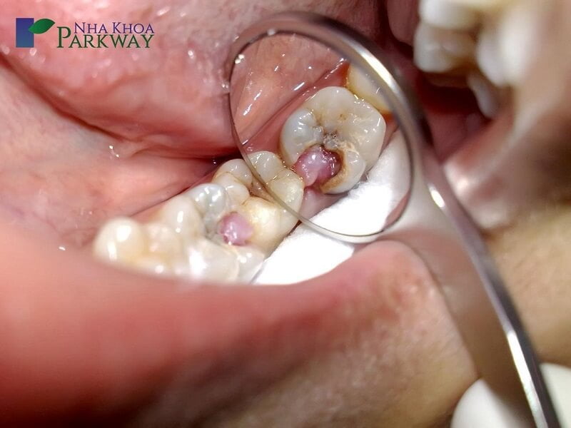 Viêm tủy là tình trạng sâu răng nặng nề, gây đau nhức khó chịu